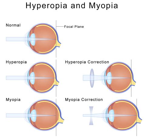 The study showed a halting of the progression of <b>myopia</b> in 81. . Myopia lens